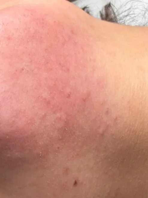 Le même menton après électrolyse : peau nette